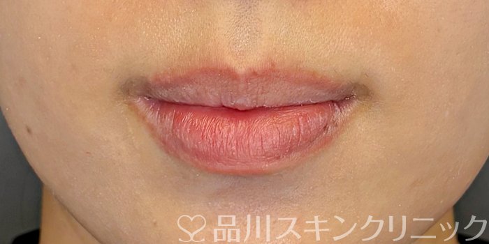 症例NO.71732のBEFORE写真