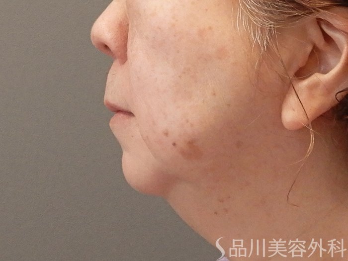 症例NO.70442のBEFORE写真