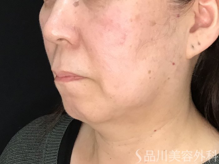 症例NO.69987のBEFORE写真