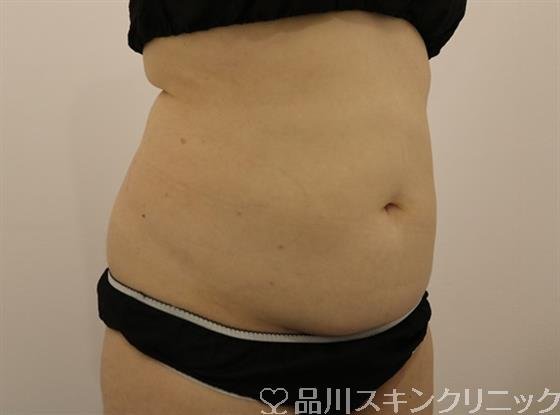 症例NO.44501のBEFORE写真