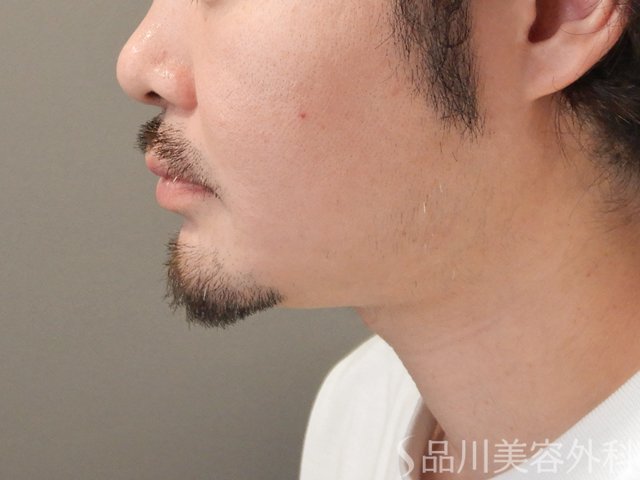 症例NO.74957のAFTER写真