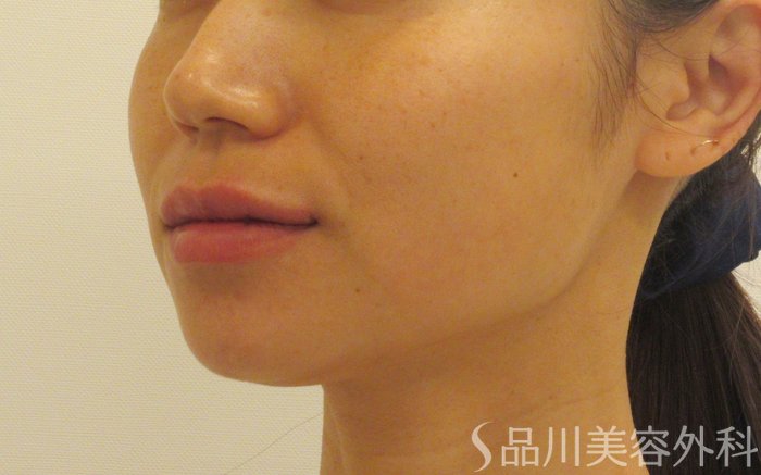 症例NO.70897のAFTER写真