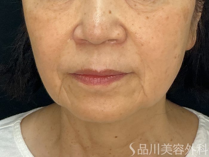 症例NO.71865のBEFORE写真