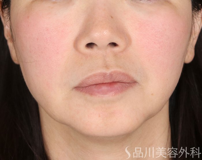 症例NO.72626のBEFORE写真