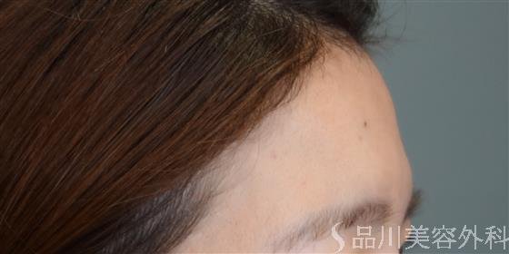 症例NO.51377のBEFORE写真