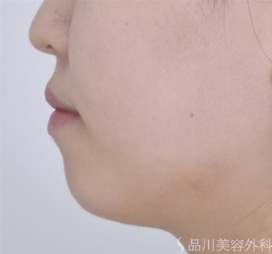 症例NO.50066のBEFORE写真