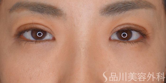 症例NO.73197のAFTER写真