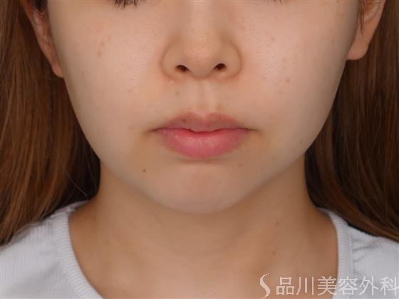 症例NO.51743のBEFORE写真