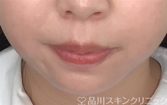 症例NO.52174のAFTER写真