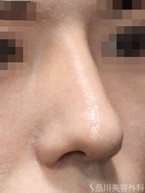 症例NO.75215のAFTER写真