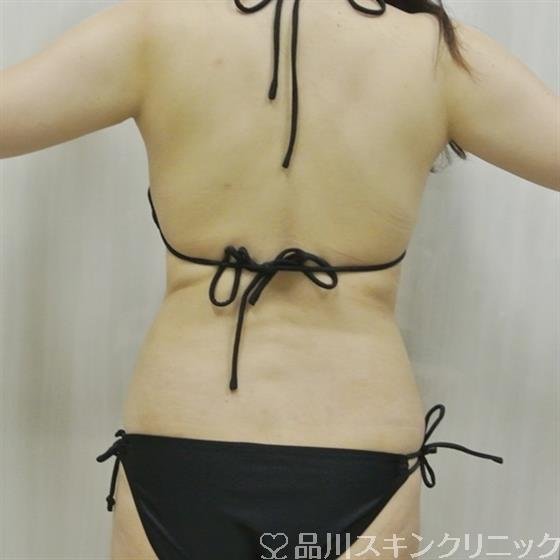 症例NO.28524のAFTER写真