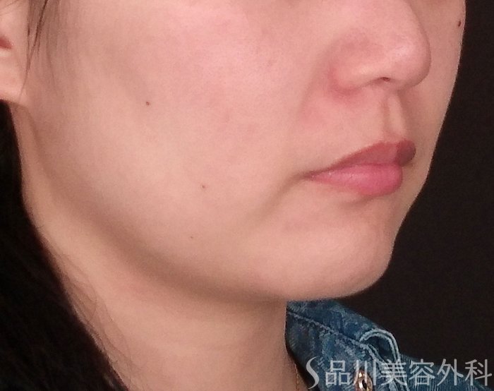 症例NO.70951のBEFORE写真