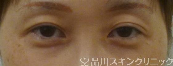 症例NO.38393のBEFORE写真