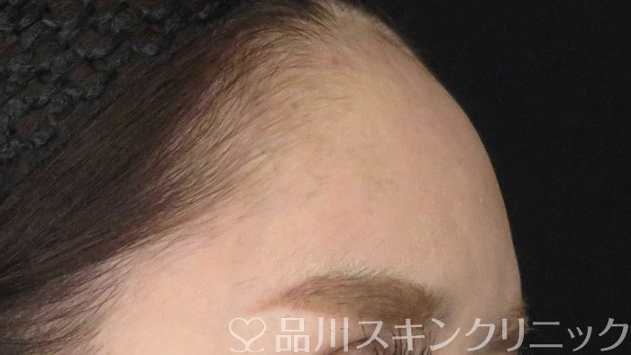 症例NO.71804のAFTER写真