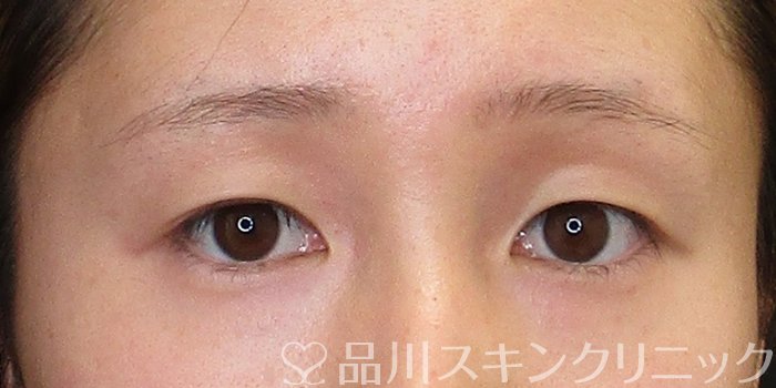 症例NO.75295のBEFORE写真