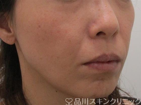 症例NO.43048のBEFORE写真