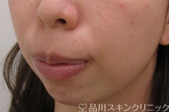 症例NO.39635のBEFORE写真