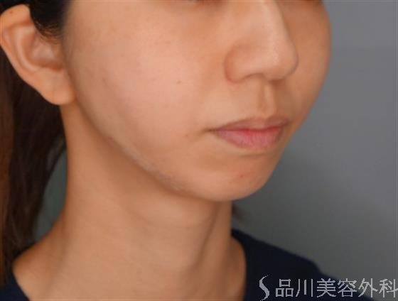 症例NO.54720のAFTER写真