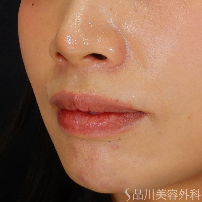 症例NO.67995のBEFORE写真