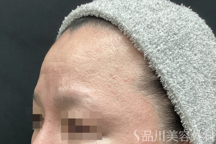 症例NO.67802のBEFORE写真