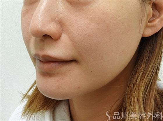 症例NO.34408のBEFORE写真