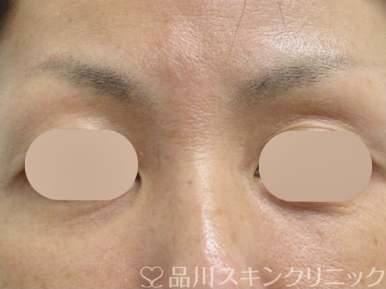 症例NO.69301のAFTER写真