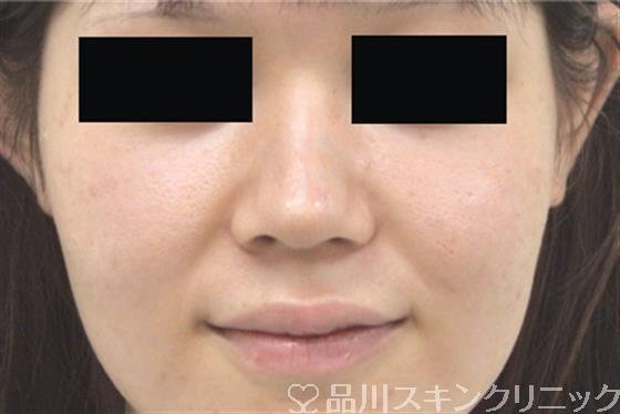 症例NO.29641のBEFORE写真