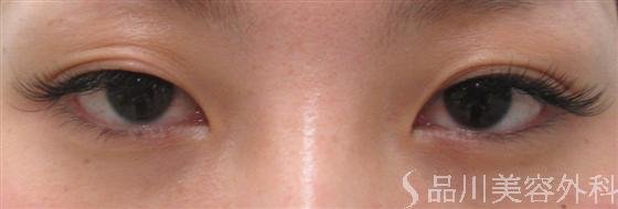 症例NO.20058のBEFORE写真