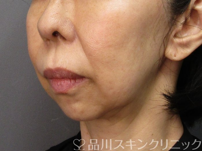 症例NO.75144のBEFORE写真