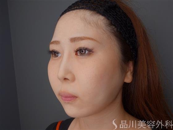 症例NO.61891のAFTER写真