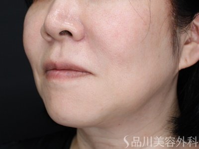 症例NO.72004のBEFORE写真