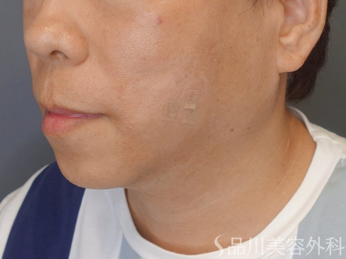 症例NO.72071のAFTER写真