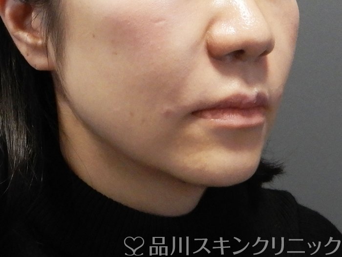 症例NO.73000のAFTER写真