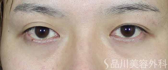 症例NO.71972のBEFORE写真