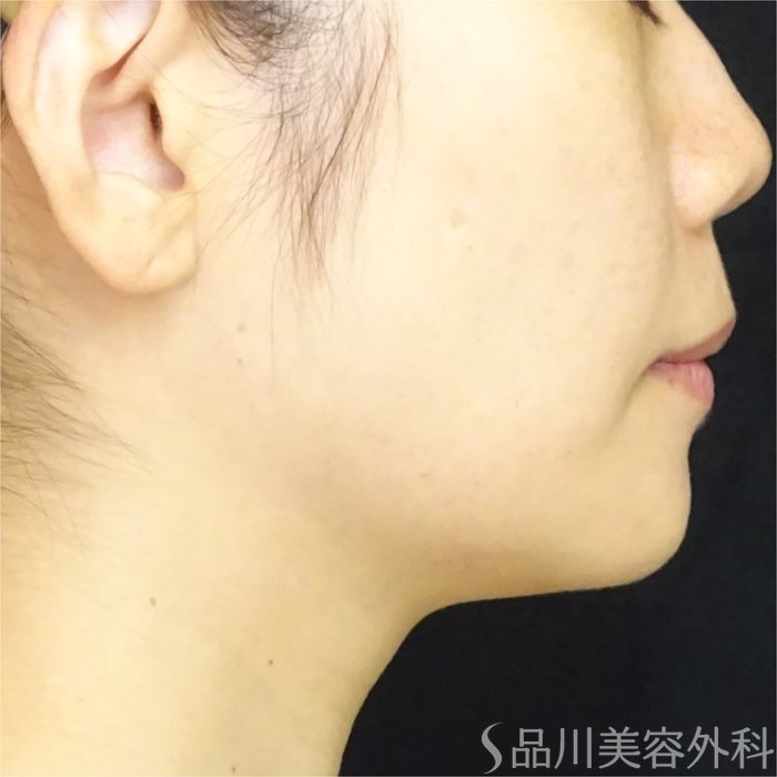 症例NO.69449のBEFORE写真