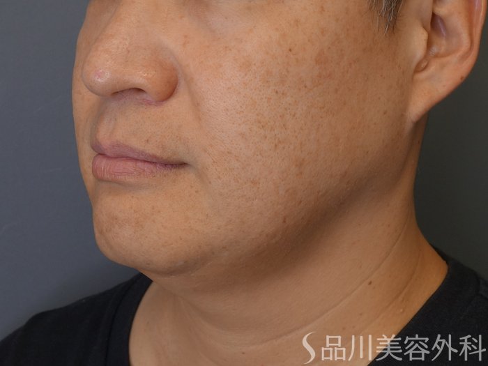 症例NO.73068のBEFORE写真