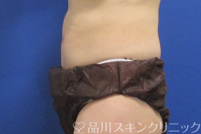 症例NO.70080のAFTER写真