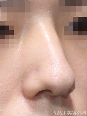 症例NO.75215のBEFORE写真