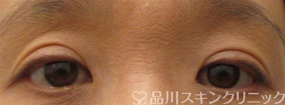 症例NO.26210のAFTER写真