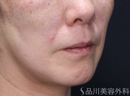 症例NO.73605のAFTER写真