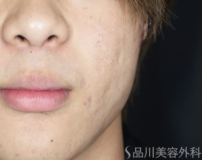 症例NO.71747のAFTER写真