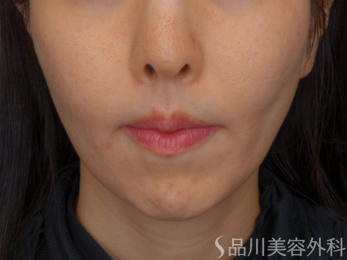 症例NO.73030のBEFORE写真