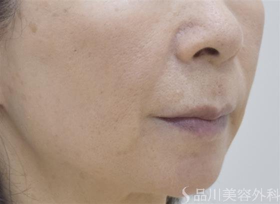 症例NO.49184のAFTER写真