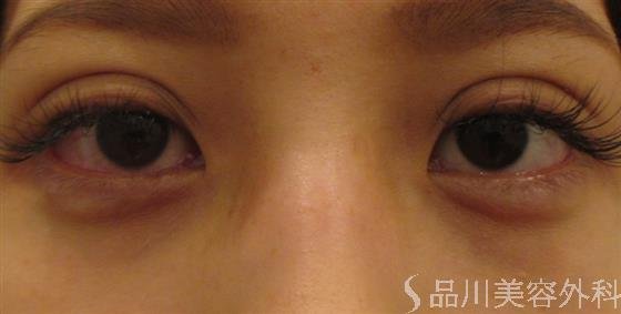 症例NO.23204のAFTER写真