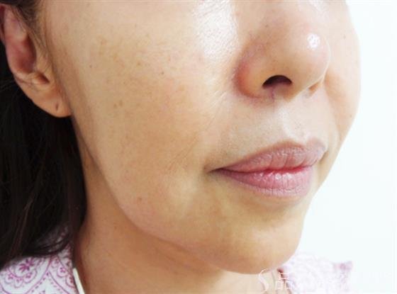 症例NO.24293のBEFORE写真