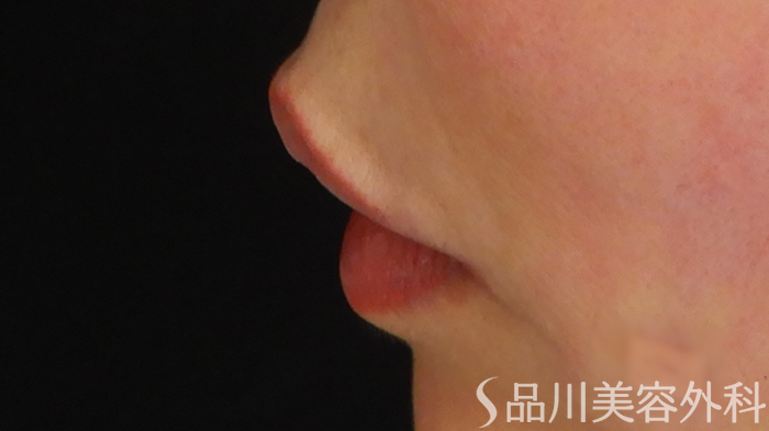 症例NO.69769のAFTER写真