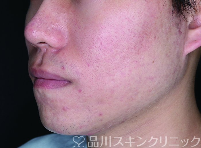 症例NO.73016のAFTER写真