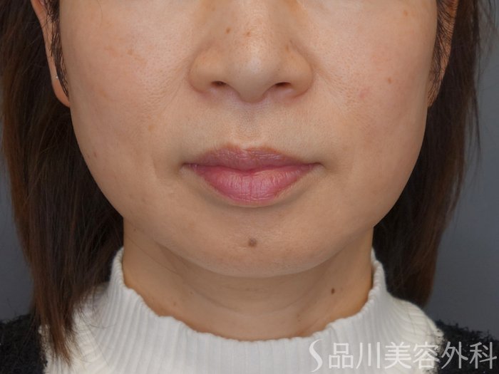 症例NO.72873のBEFORE写真