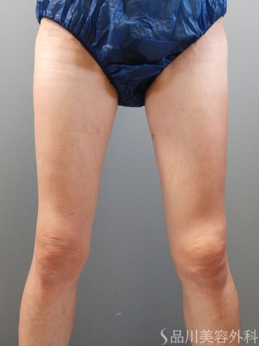 症例NO.71076のBEFORE写真