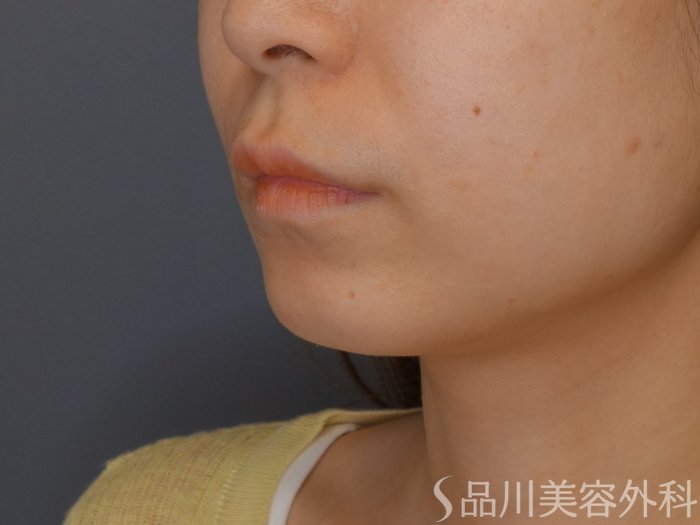 症例NO.70473のBEFORE写真